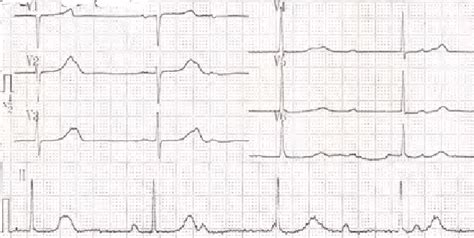 Concerns With Metoprolol Causing Alop.